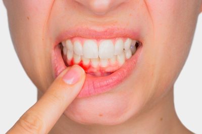 Periodoncia